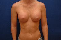 Breast Augmentation Before and After | Brzowski Plastic Surgery