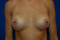 Breast Augmentation Before and After | Brzowski Plastic Surgery