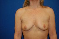 Breast Augmentation Before and After | Brzowski Plastic Surgery