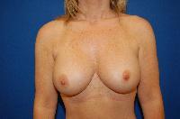 Breast Augmentation Before and After | Brzowski Plastic Surgery