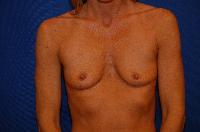 Breast Augmentation Before and After | Brzowski Plastic Surgery