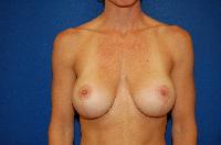 Breast Augmentation Before and After | Brzowski Plastic Surgery