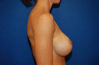 Breast Augmentation Before and After | Brzowski Plastic Surgery