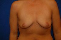 Breast Augmentation Before and After | Brzowski Plastic Surgery