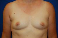 Breast Augmentation Before and After | Brzowski Plastic Surgery