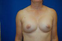 Breast Augmentation Before and After | Brzowski Plastic Surgery