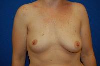 Breast Augmentation Before and After | Brzowski Plastic Surgery