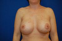 Breast Augmentation Before and After | Brzowski Plastic Surgery