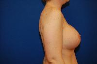 Breast Augmentation Before and After | Brzowski Plastic Surgery