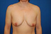 Breast Augmentation Before and After | Brzowski Plastic Surgery