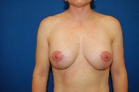 Breast Augmentation Before and After | Brzowski Plastic Surgery