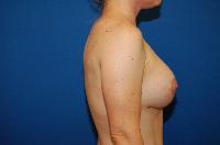 Breast Augmentation Before and After | Brzowski Plastic Surgery