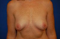 Breast Augmentation Before and After | Brzowski Plastic Surgery