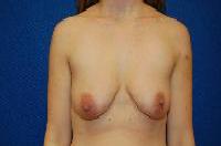 Breast Augmentation Before and After | Brzowski Plastic Surgery