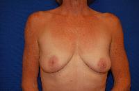 Breast Augmentation Before and After | Brzowski Plastic Surgery