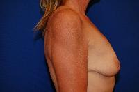 Breast Augmentation Before and After | Brzowski Plastic Surgery