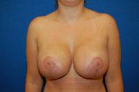 Breast Augmentation Before and After | Brzowski Plastic Surgery