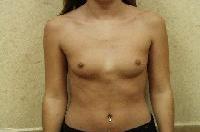 Breast Augmentation Before and After | Brzowski Plastic Surgery