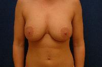 Breast Augmentation Before and After | Brzowski Plastic Surgery