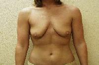Breast Augmentation Before and After | Brzowski Plastic Surgery
