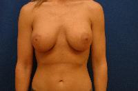 Breast Augmentation Before and After | Brzowski Plastic Surgery