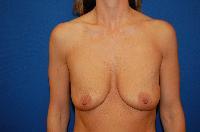 Breast Augmentation Before and After | Brzowski Plastic Surgery