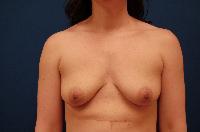 Breast Augmentation Before and After | Brzowski Plastic Surgery