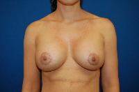 Breast Augmentation Before and After | Brzowski Plastic Surgery