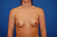 Breast Augmentation Before and After | Brzowski Plastic Surgery