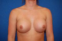 Breast Augmentation Before and After | Brzowski Plastic Surgery