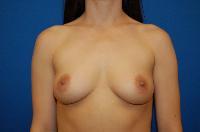 Breast Augmentation Before and After | Brzowski Plastic Surgery