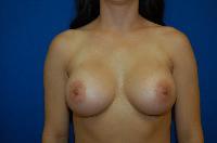 Breast Augmentation Before and After | Brzowski Plastic Surgery