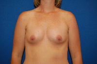 Breast Augmentation Before and After | Brzowski Plastic Surgery