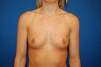 Breast Augmentation Before and After | Brzowski Plastic Surgery