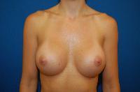 Breast Augmentation Before and After | Brzowski Plastic Surgery