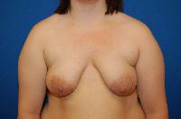 Breast Augmentation Before and After | Brzowski Plastic Surgery