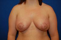 Breast Augmentation Before and After | Brzowski Plastic Surgery