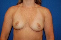 Breast Augmentation Before and After | Brzowski Plastic Surgery