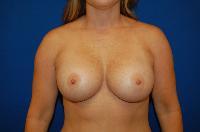 Breast Augmentation Before and After | Brzowski Plastic Surgery