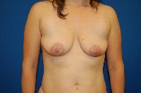 Breast Augmentation Before and After | Brzowski Plastic Surgery