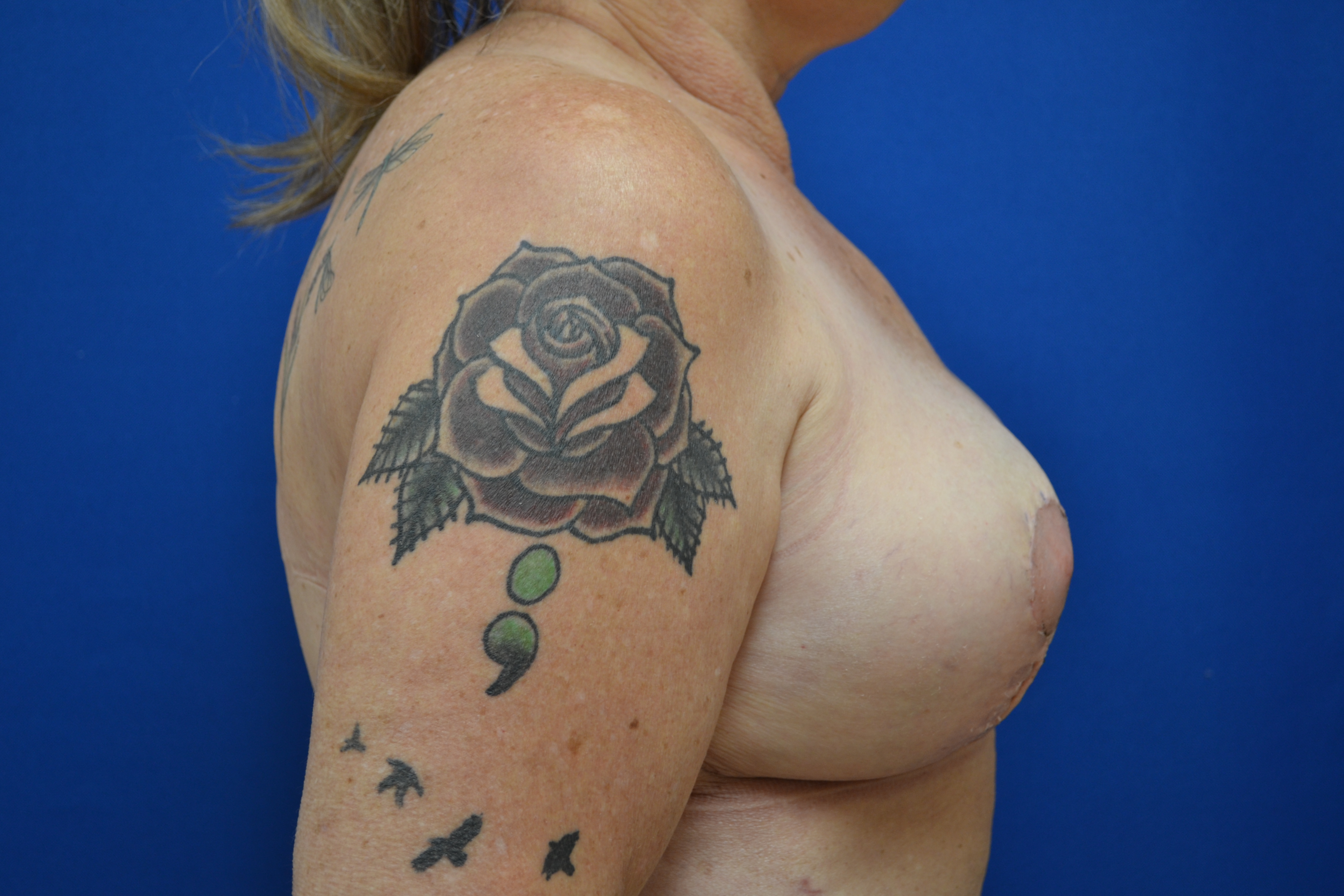 Breast Implant Removal With Lift Before and After | Brzowski Plastic Surgery