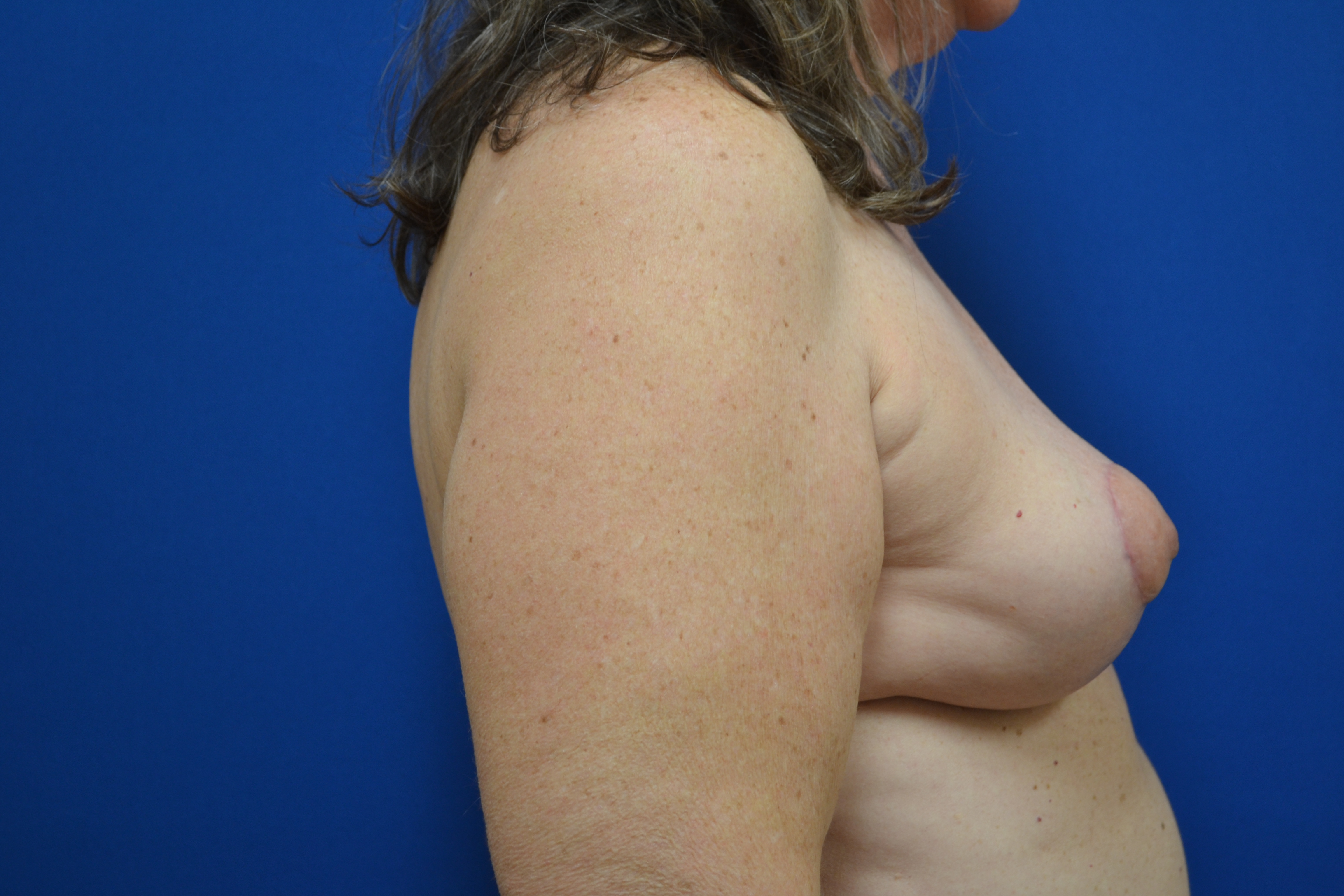 Breast Implant Removal With Lift Before and After | Brzowski Plastic Surgery