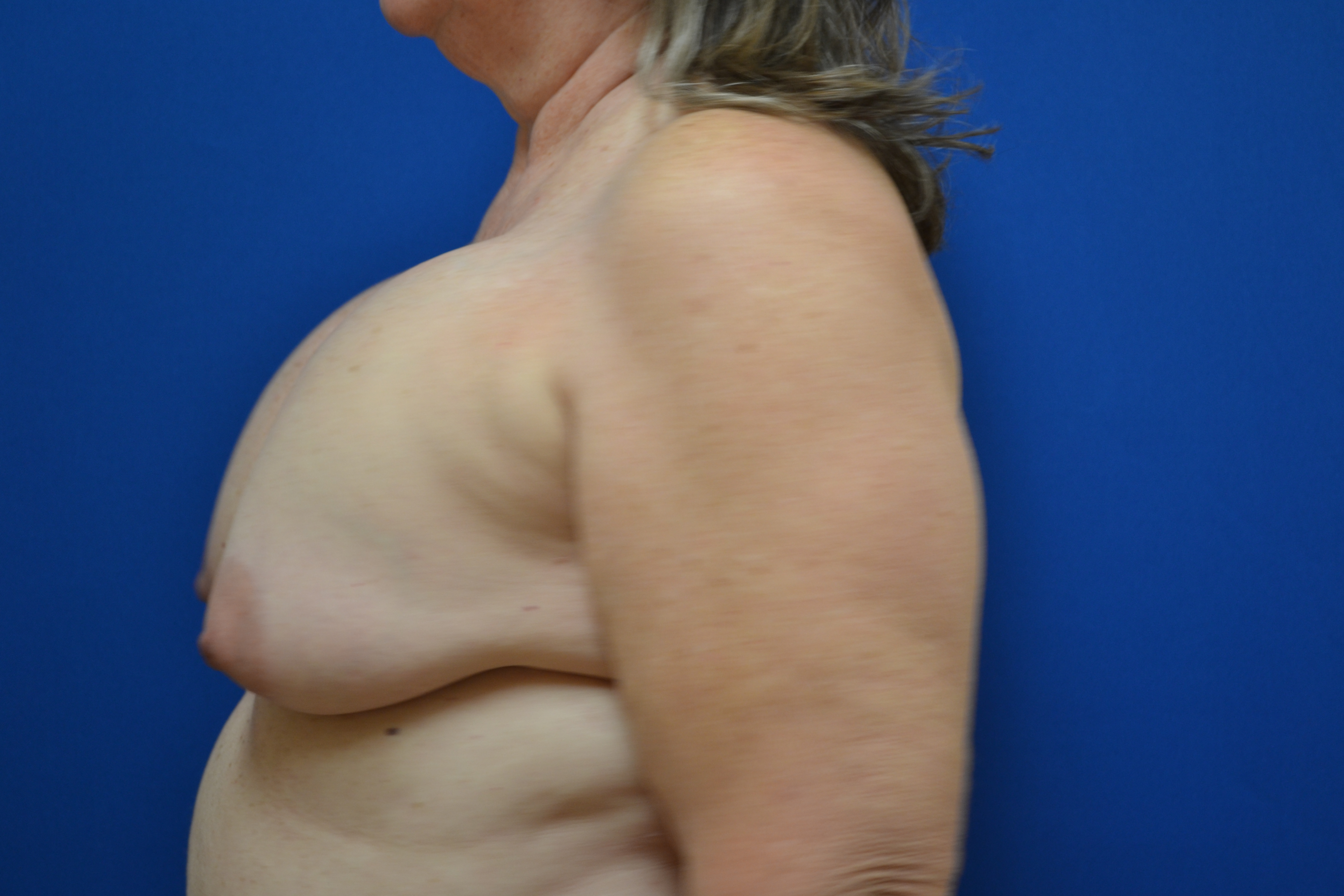 Breast Implant Removal With Lift Before and After | Brzowski Plastic Surgery