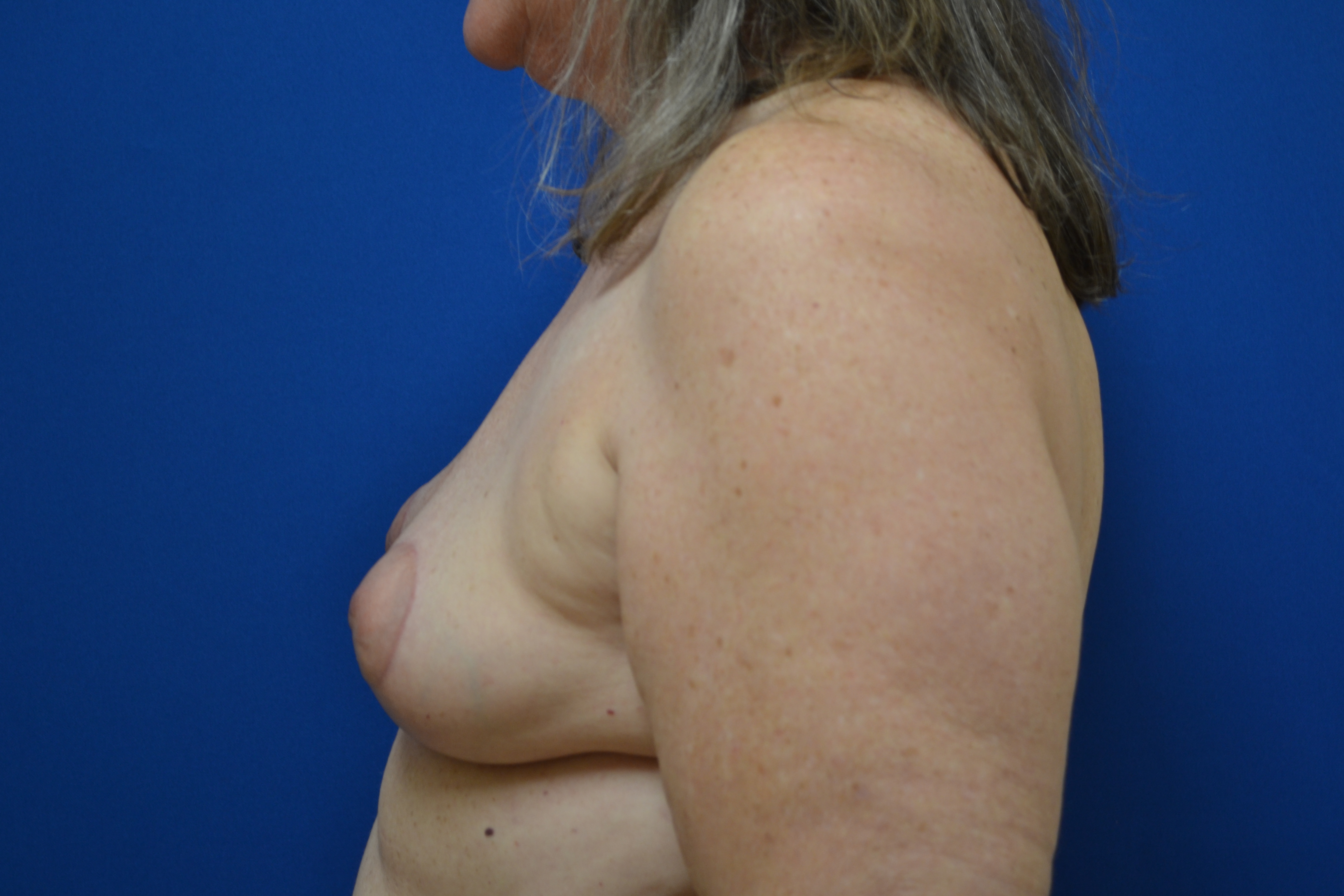 Breast Implant Removal With Lift Before and After | Brzowski Plastic Surgery