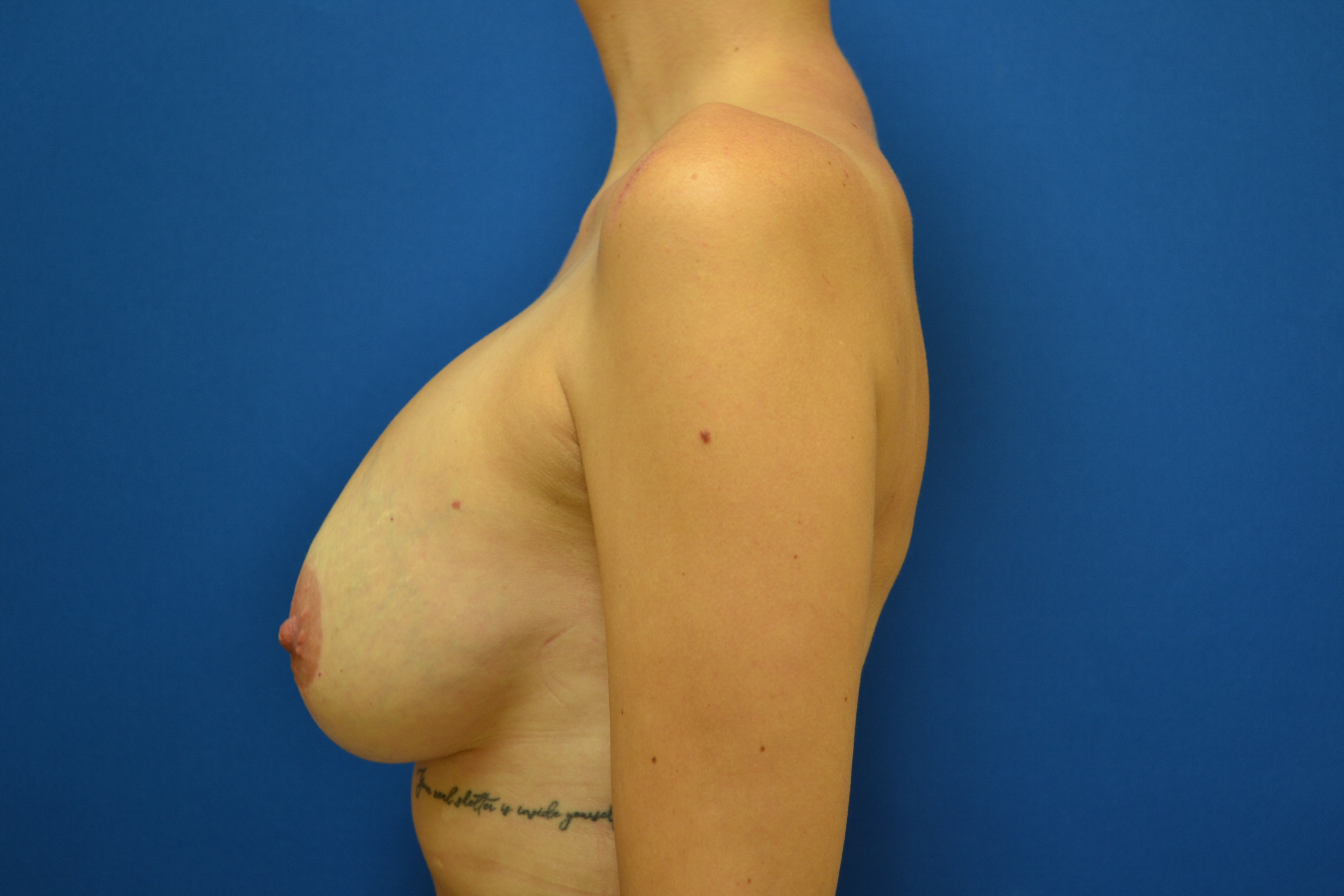 Breast Implant Removal Before and After | Brzowski Plastic Surgery