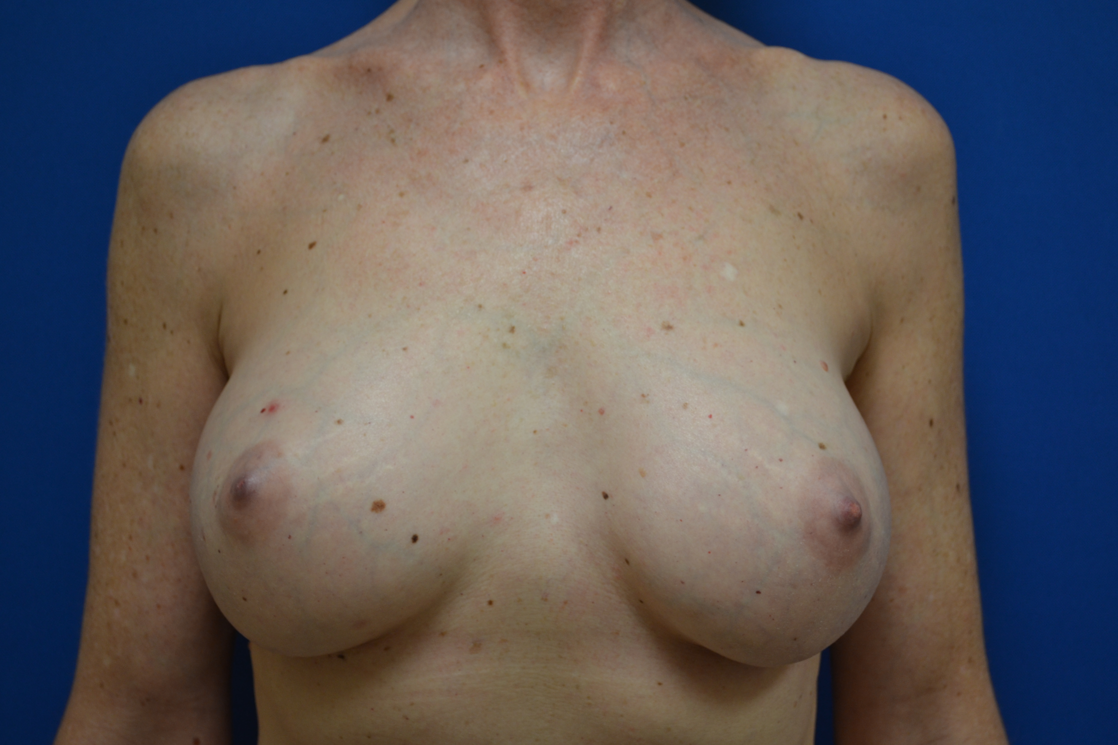 Breast Implant Removal Before and After | Brzowski Plastic Surgery