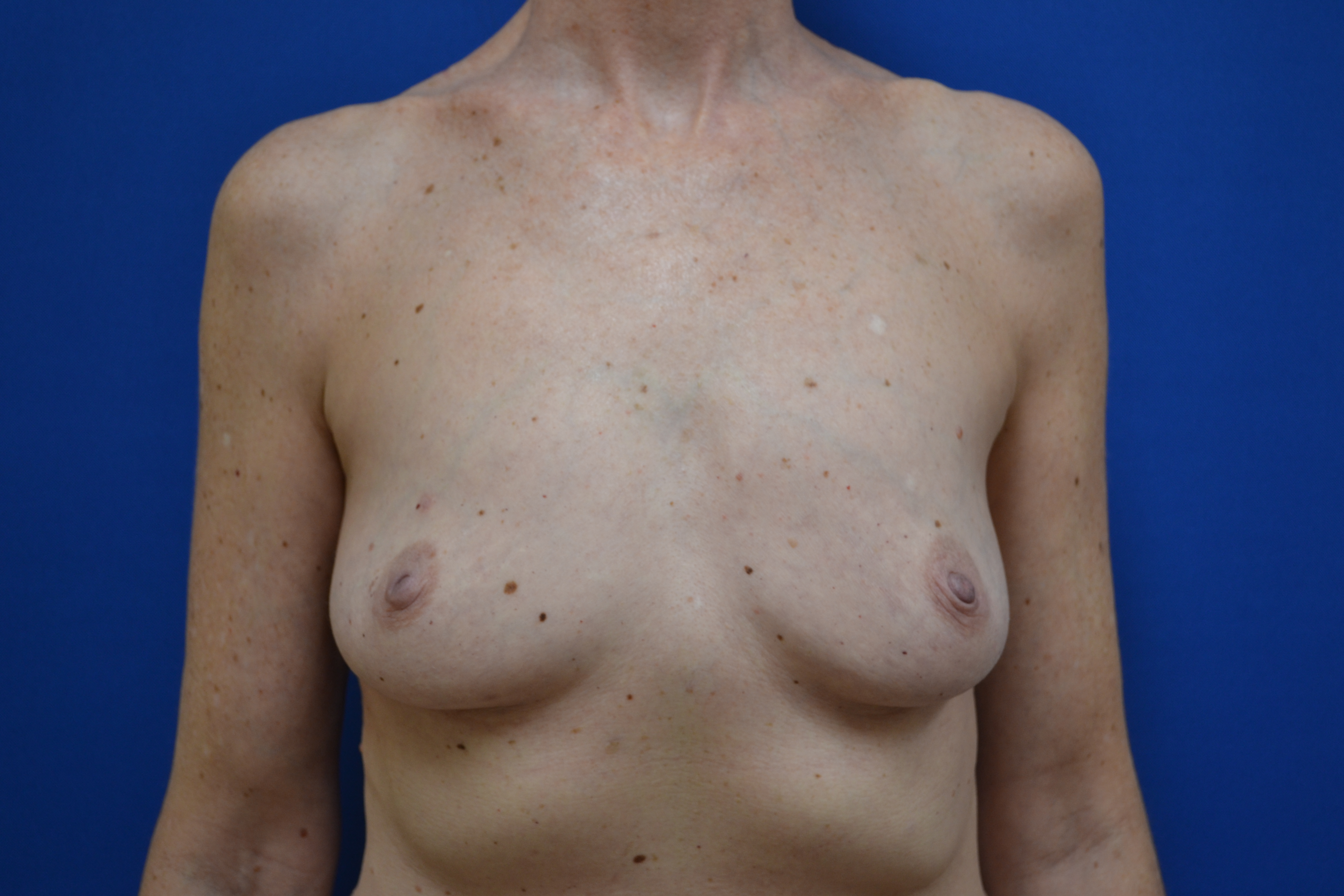 Breast Implant Removal Before and After | Brzowski Plastic Surgery