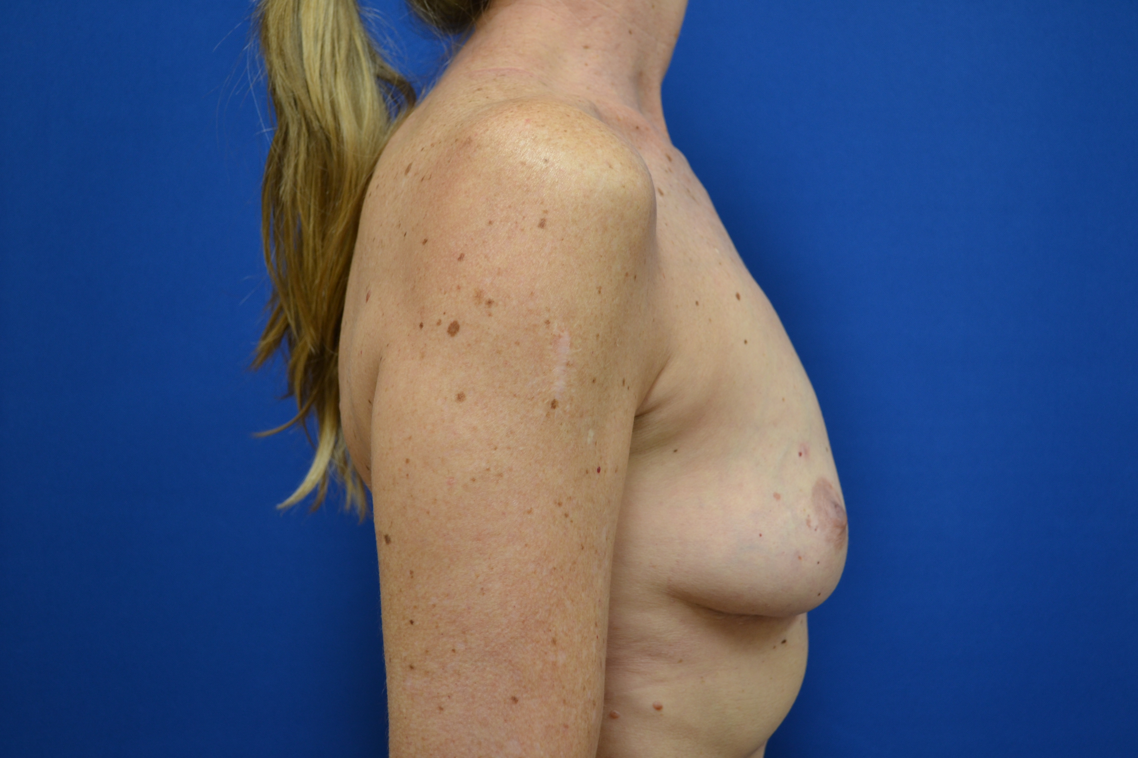 Breast Implant Removal Before and After | Brzowski Plastic Surgery