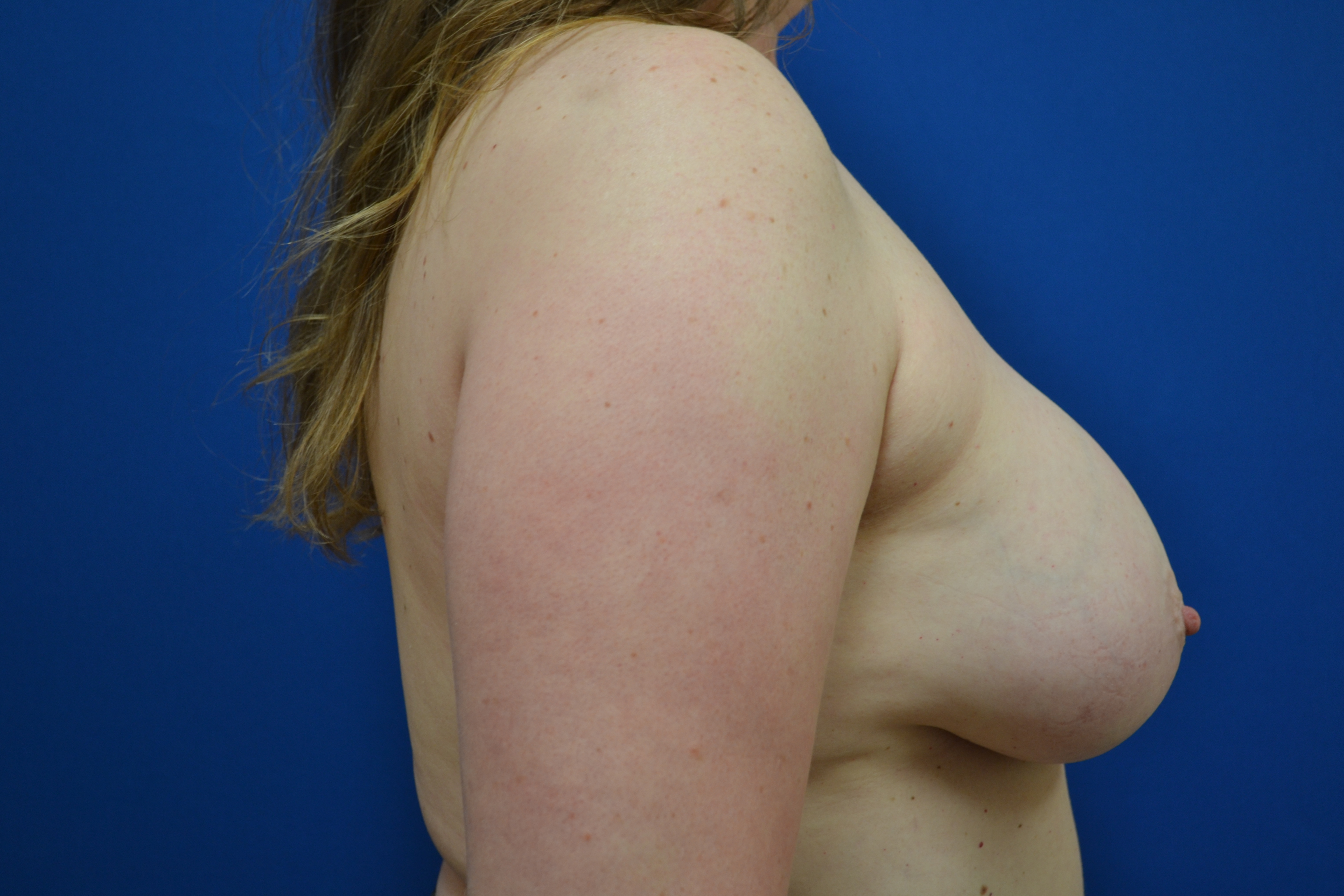 Breast Implant Removal Before and After | Brzowski Plastic Surgery