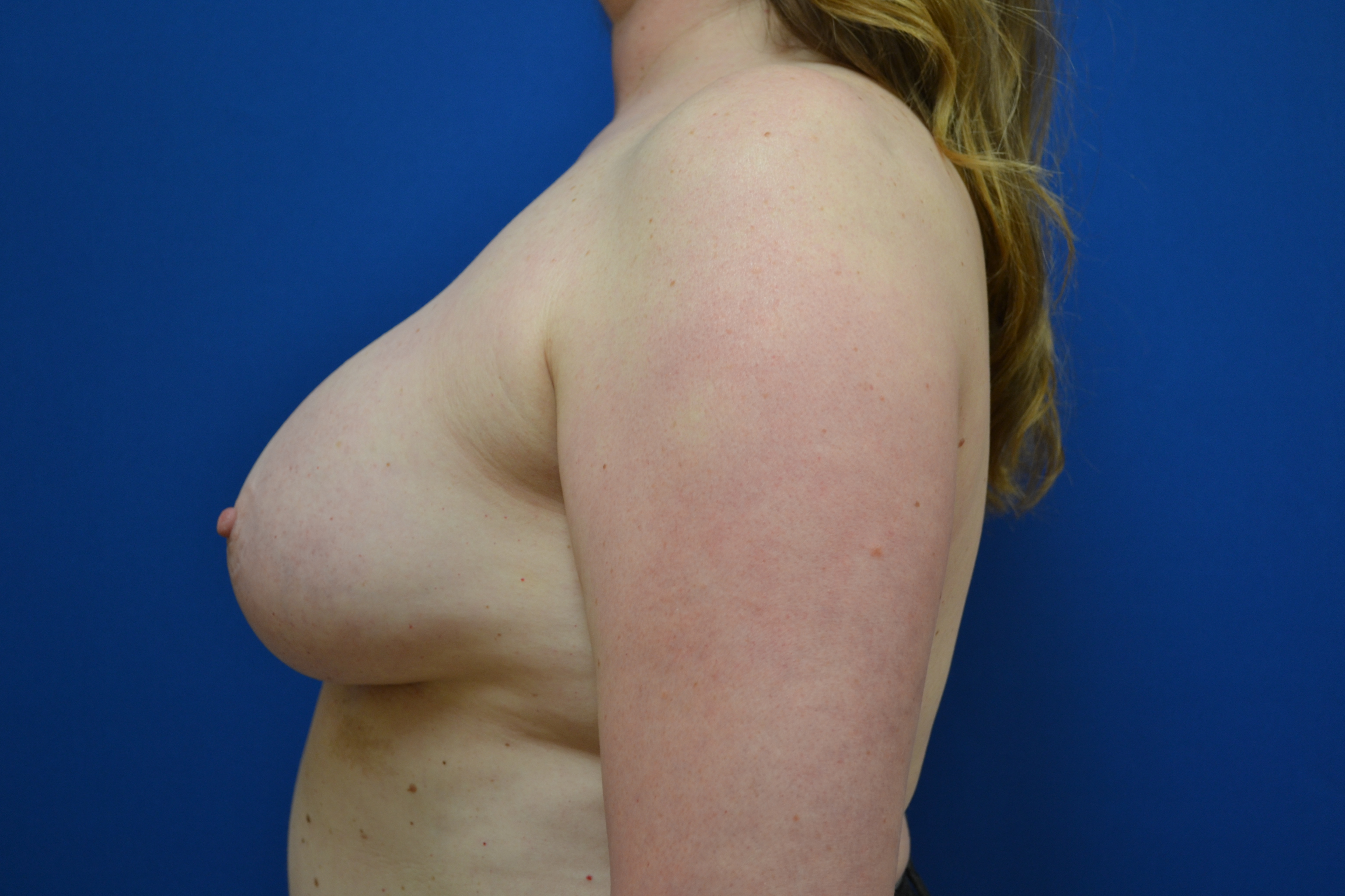 Breast Implant Removal Before and After | Brzowski Plastic Surgery